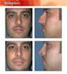 Rhinoplasty