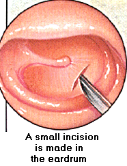 Small Incision is made in the Eardrum