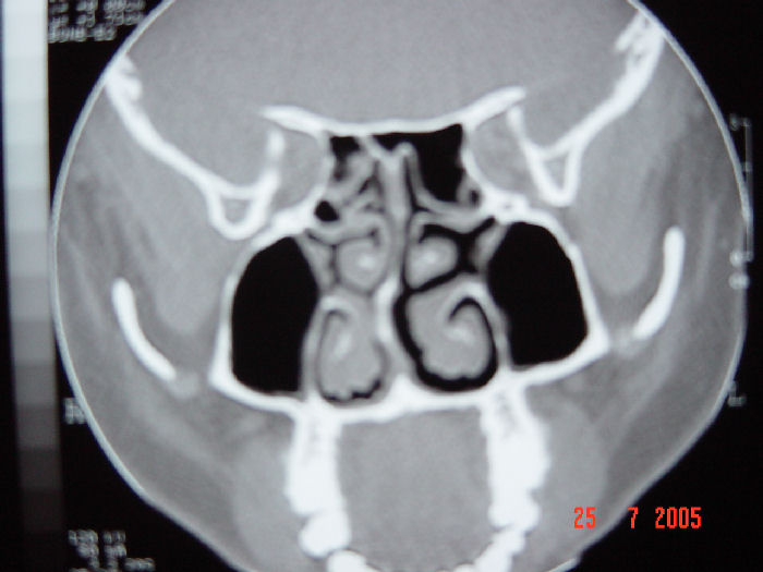Septal Deviation and Chronic Rhinosinusitis