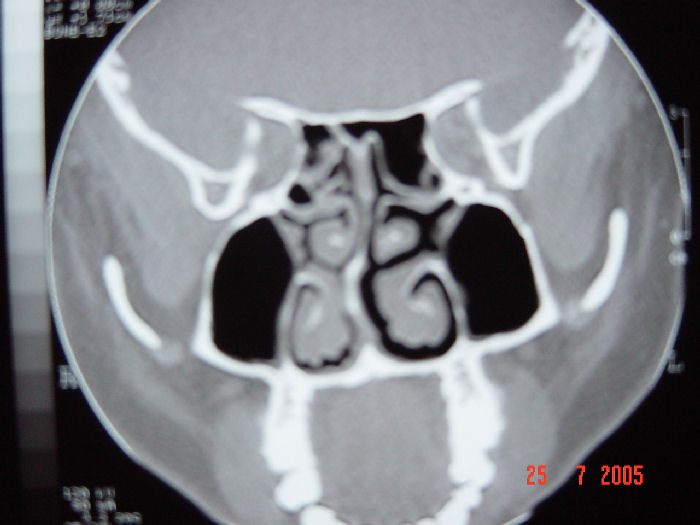 Desviación Septal y Rinosinusitis Crónica