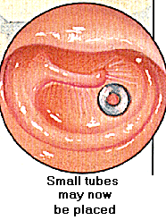 Small tubes may now be placed